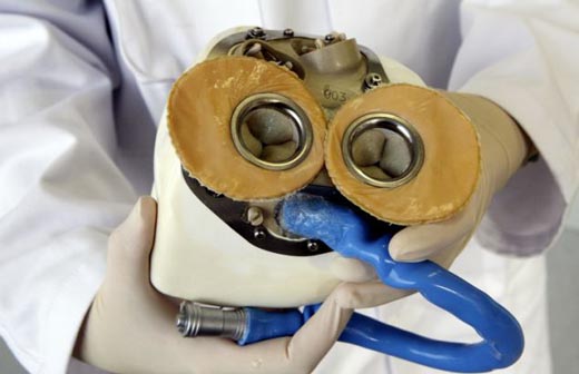 first artificial heart transplant-1